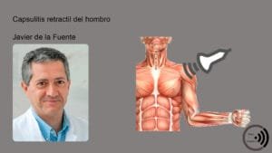 9 Capsulitis retractil del hombro 1 curso ecografia V49 Capsulitis retráctil del hombro Antonio León