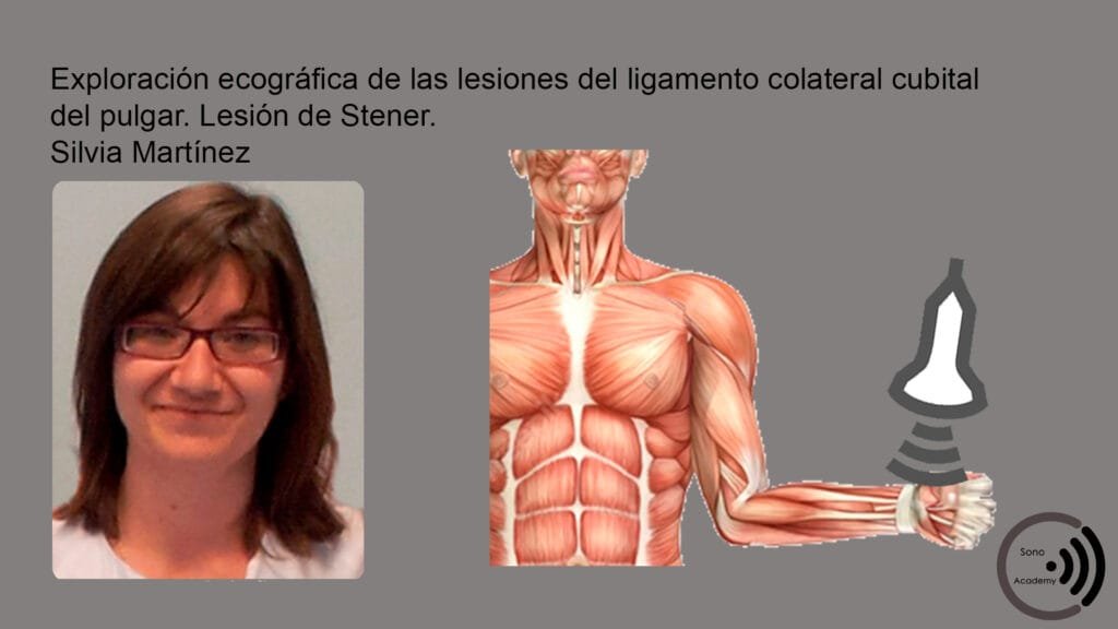 CMM 22 Exploracion ecografica lesion de Stener curso ecografia Exploración ecográfica de las lesiones del ligamento colateral cubital del pulgar. Lesión de Stener. Silvia Martínez