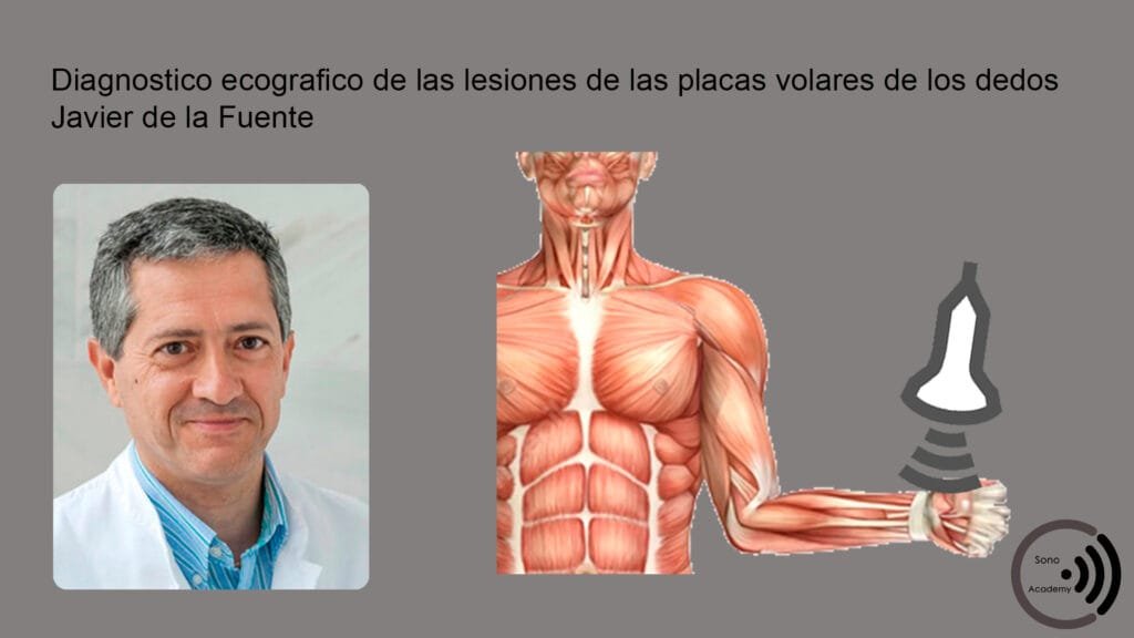 CMM 23 Diagnostico lesiones de las placas volares de los dedos curso ecografia Diagnóstico ecográfico de las lesiones de las placas volares de los dedos. Javier de la Fuente