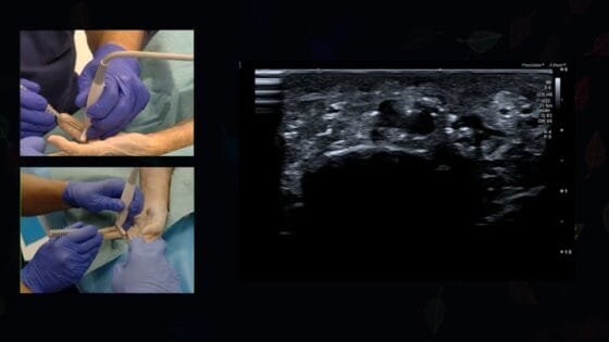 regionus 13 curso ecografia Sonocirugia polea A1 pulgar